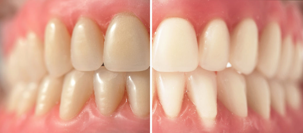 Where To Get Dentures in Hoffman Estates