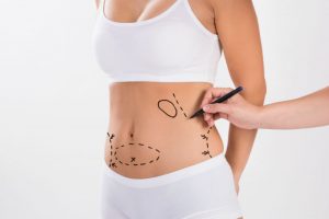 What Should You Know About a Coolsculpting Procedure?