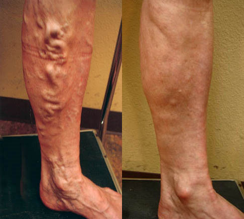 Sclerotherapy For Varicose Veins: Is It Right For You?