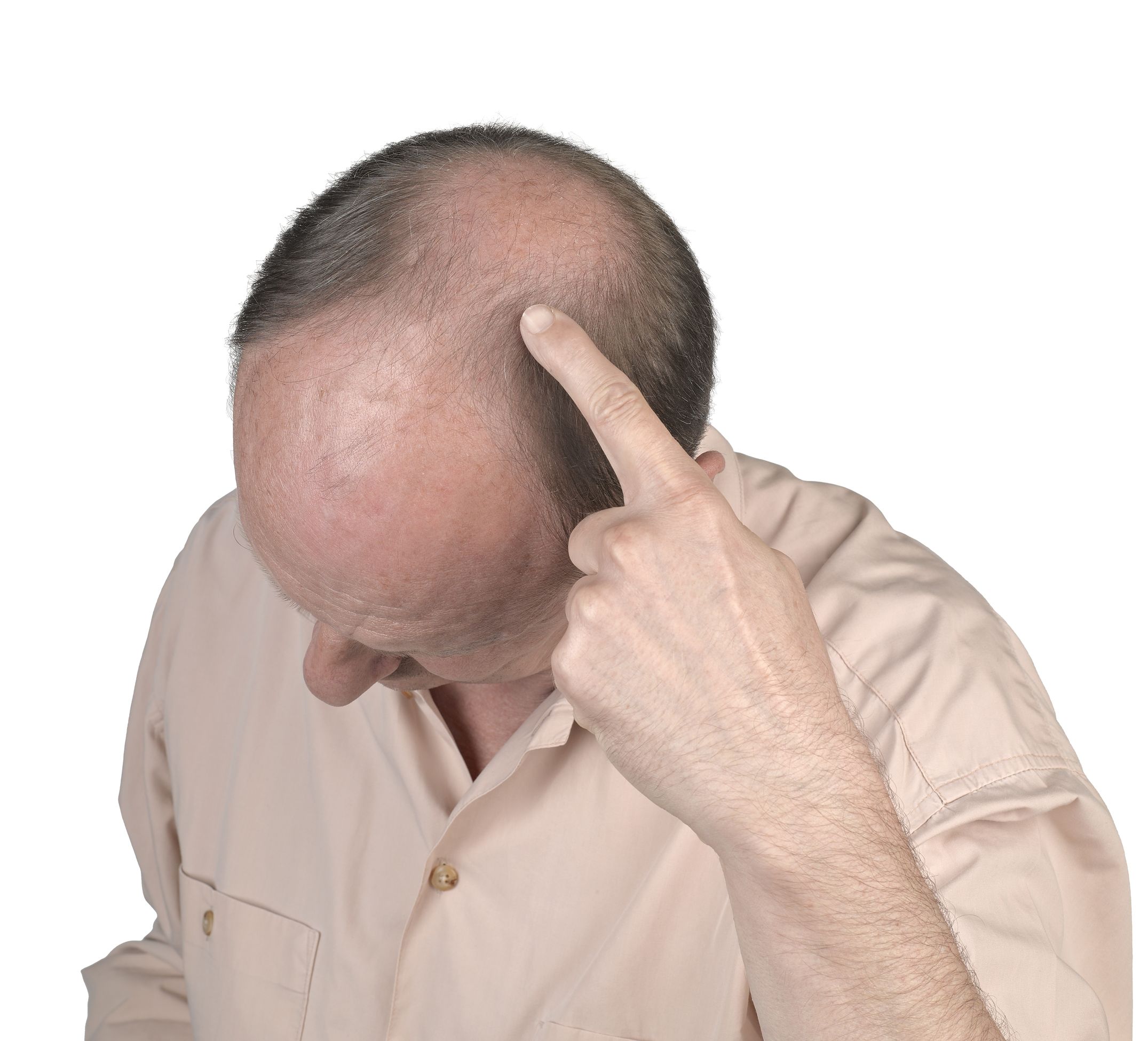 Hair Loss Treatment – You Have More Options than You May Know!