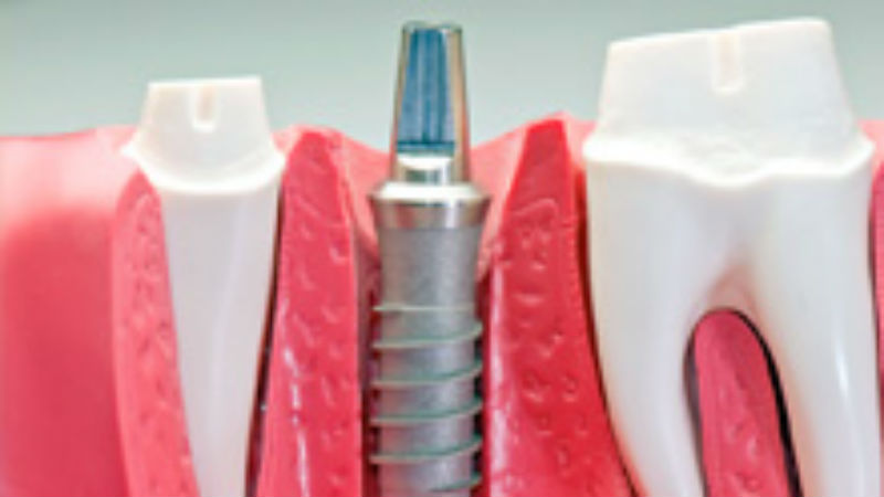 Implant Dentistry Can Change An Appearance