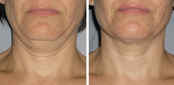 Benefits Offered by Neck Tightening in East Hampton NY