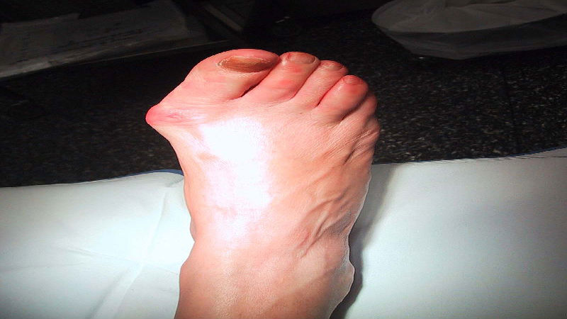 Being Open with your Bunion Doctor
