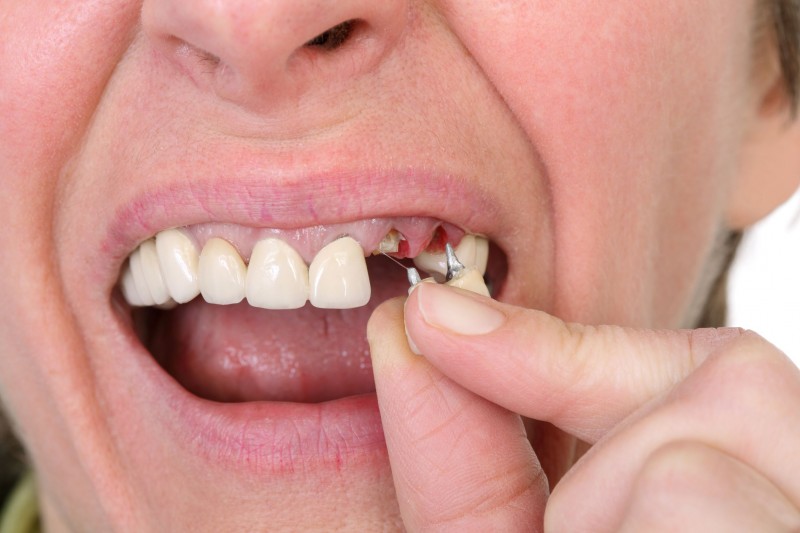 Tooth Implants In Kona Are A Permanent Solution To Missing Teeth