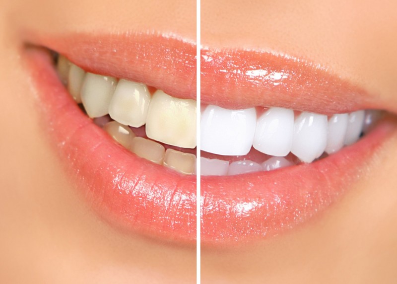 Invisalign In Chicago The Grown Up Choice