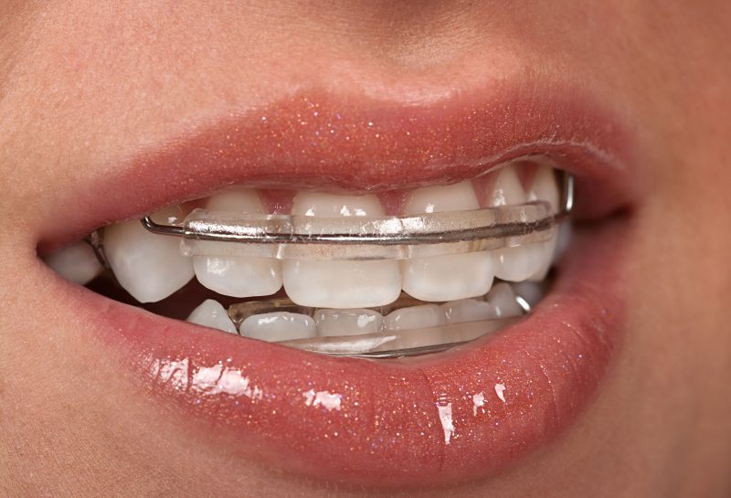 Top Tips for Making Your Invisalign Treatment Comfortable