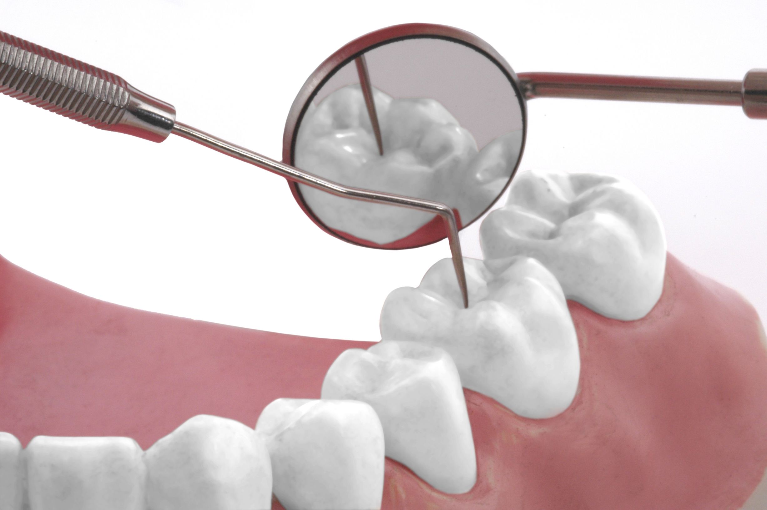 How to Prepare for Tooth Fillings