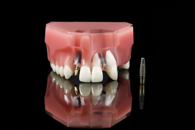 Understanding Gum Disease Treatment in Trumbull, CT