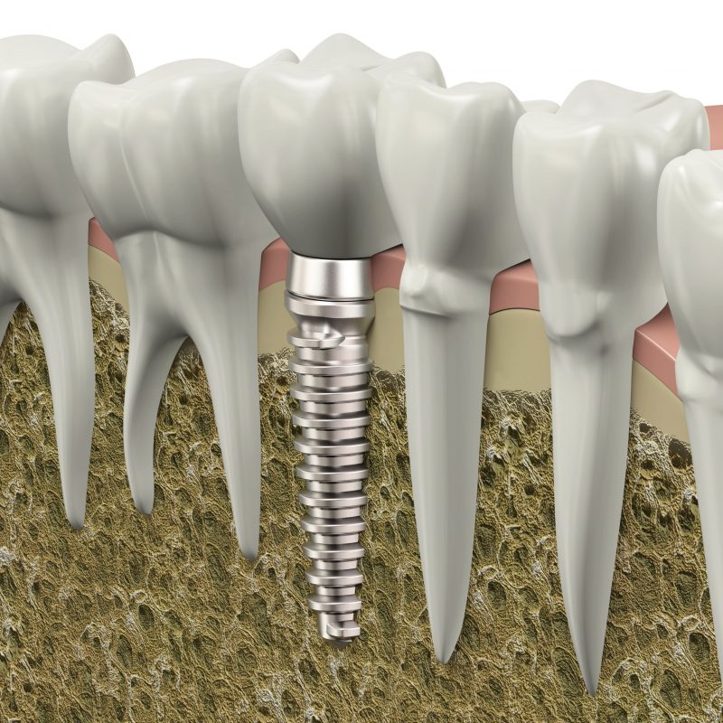 Do You Need a Tooth Implant in Marion, IA?