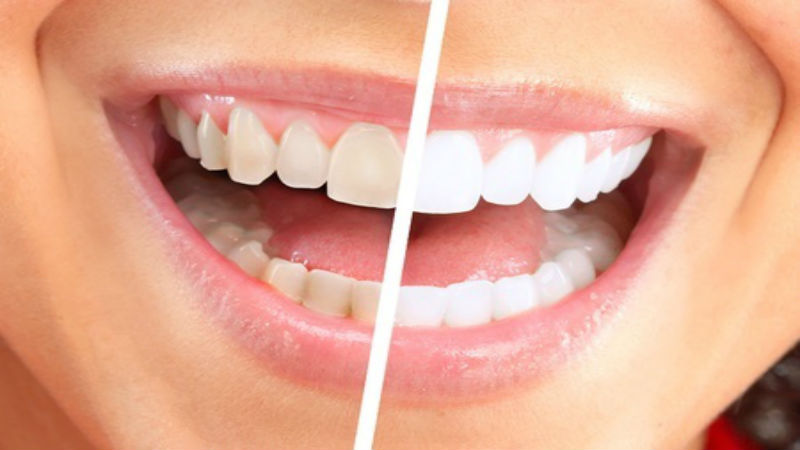 Improve Your Smile and Your Bite with Attractive Dental Implants