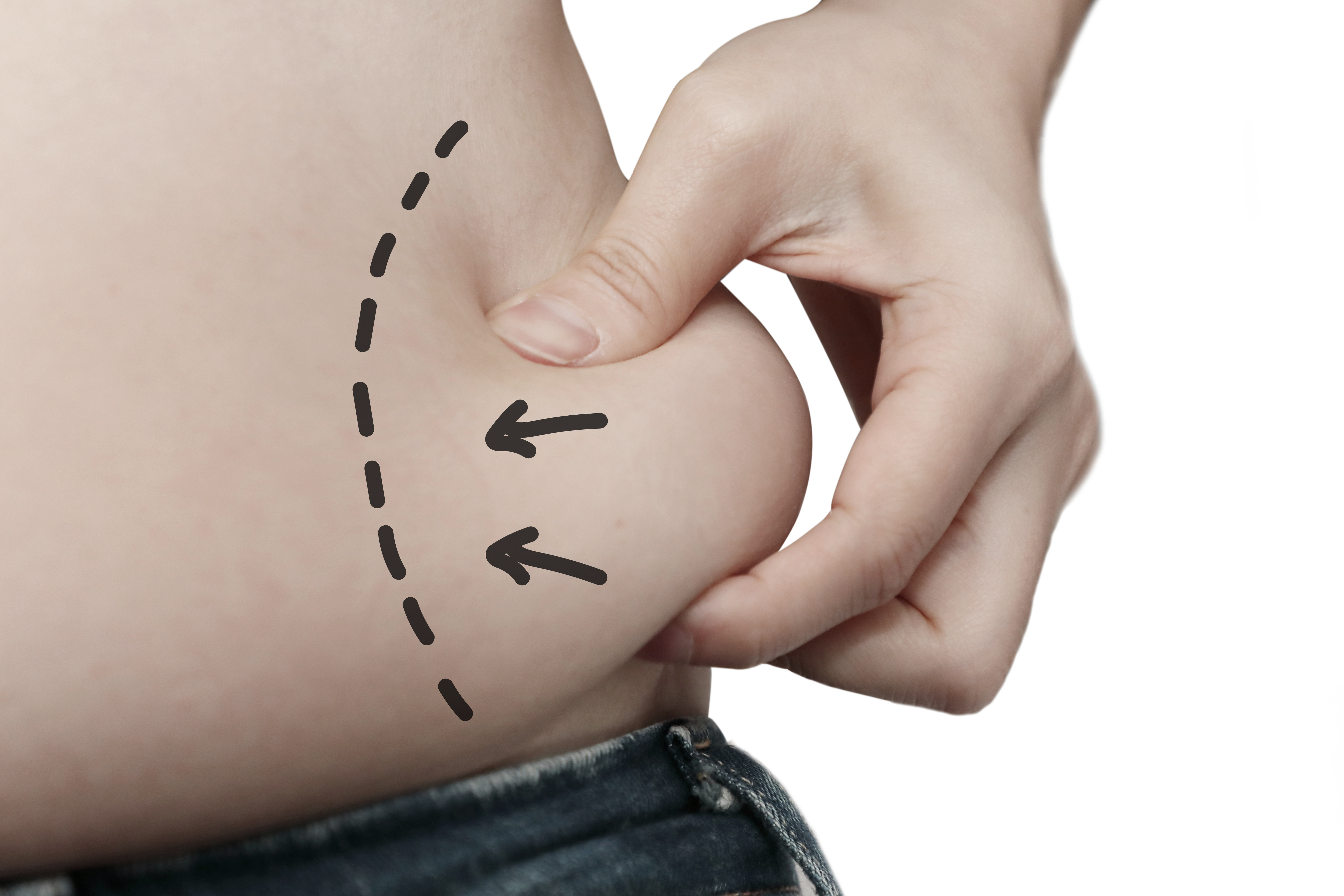 Alternatives to Liposuction Near You