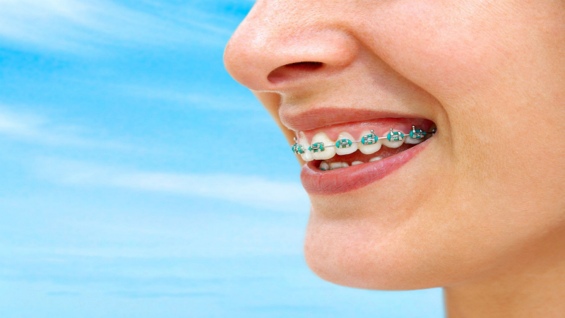 What To Know About Veneers