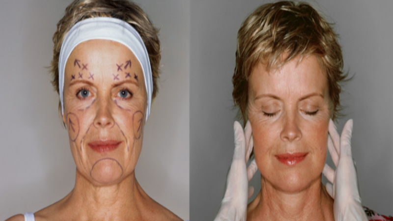 How a Neck Lift Can Make You Look Younger
