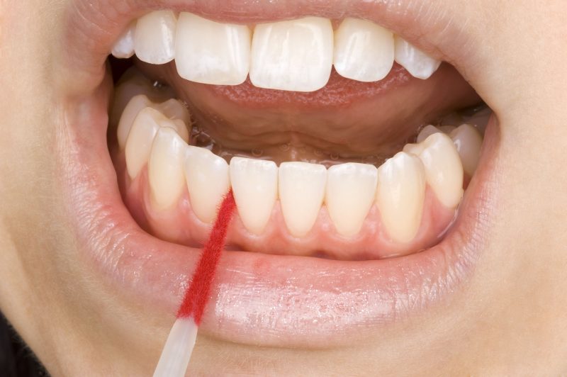 Improve the Health of Your Teeth and Gums with General Dentistry in Bernardsville NJ