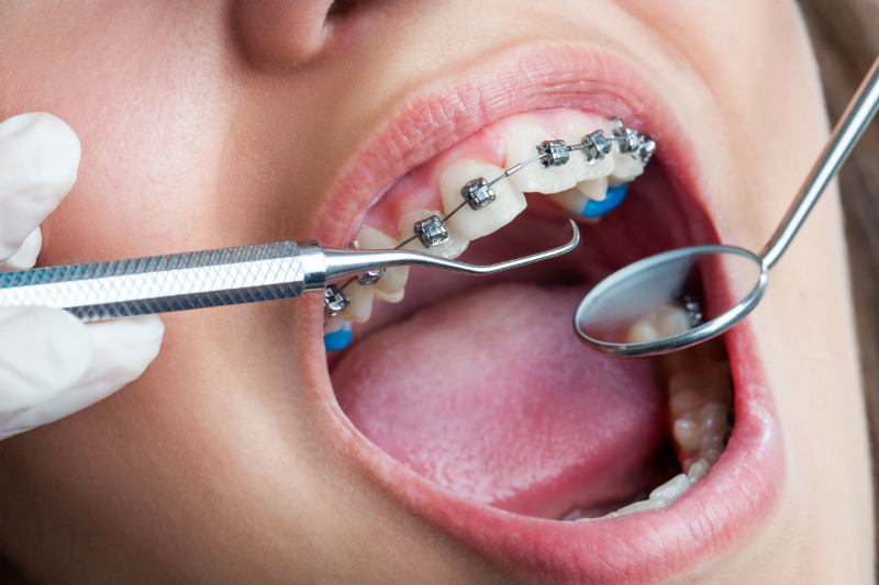 Orthodontists St Johns are About More Than Just Making Teeth Straighter