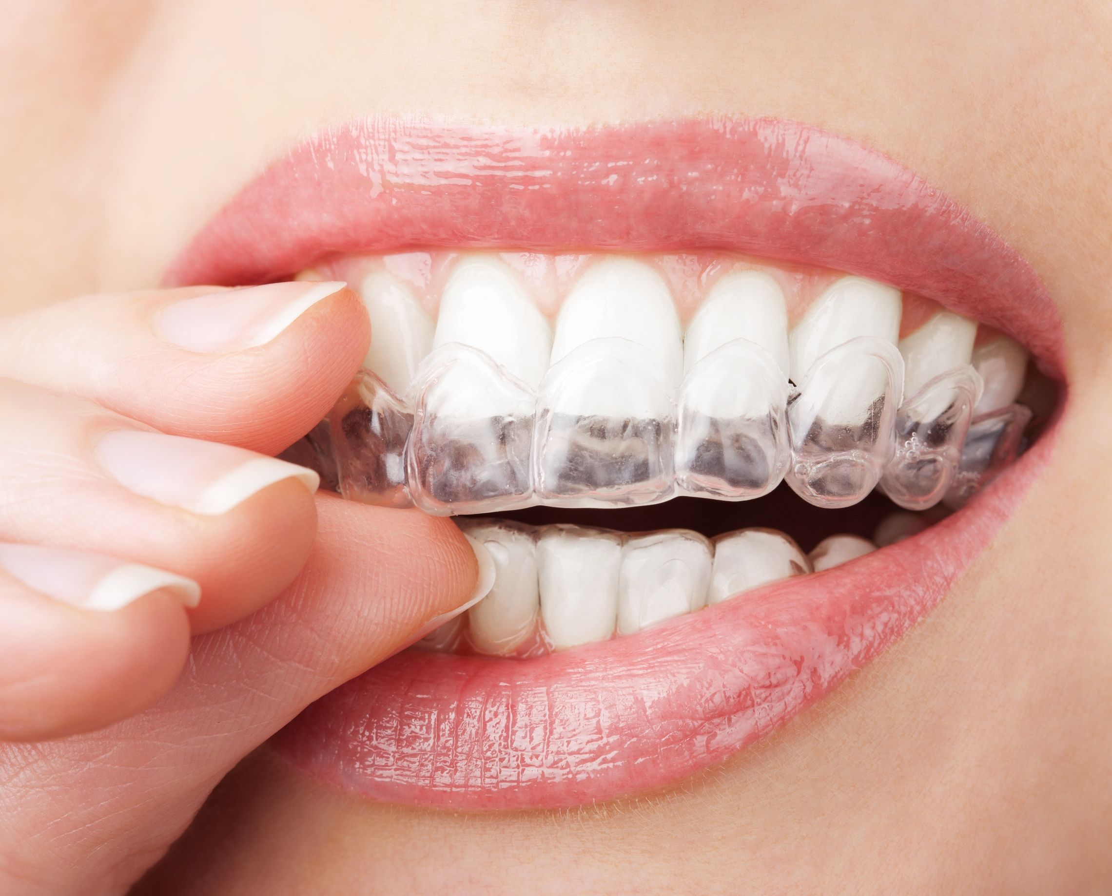 What Is Invisalign and What Makes It Unique in Mission Viejo, CA