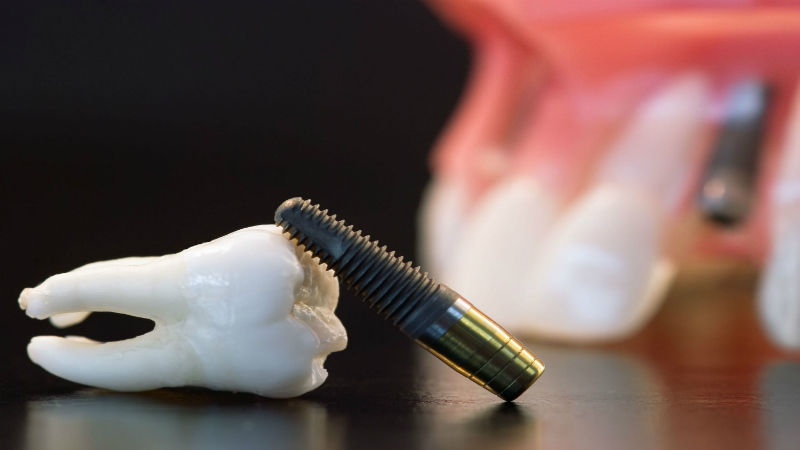 Dental Crowns in Parker CO- What You Need to Know
