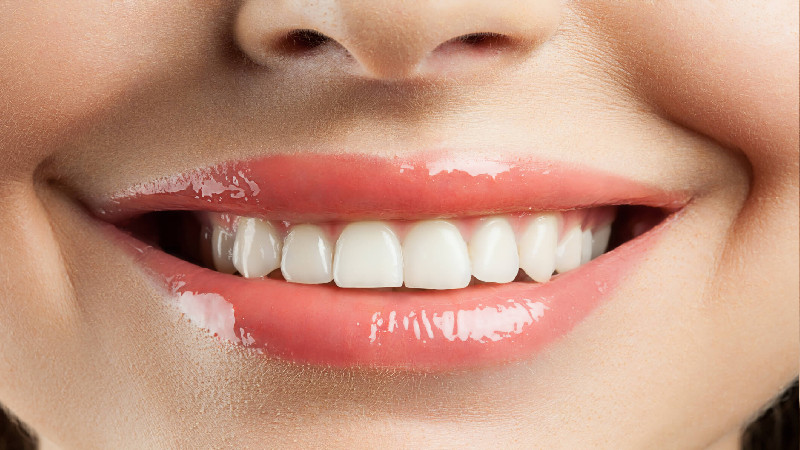 Different Types of Teeth Whitening in Macon, GA