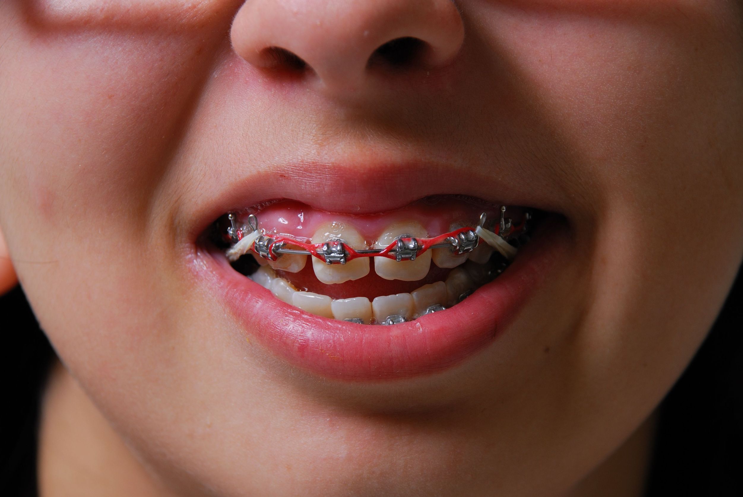 Don’t Wait: The Importance of Addressing Tooth Extractions in Chestnut Hill