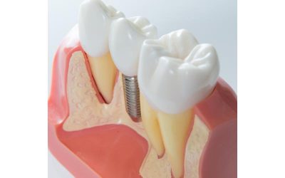 Restore Your Smile and Confidence with Permanent Tooth Replacement: Dental Implants Wall NJ
