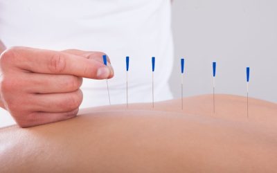 Relieve Discomfort Naturally With Acupuncture For Pain In Berkeley, CA