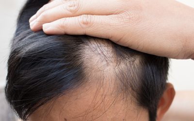 How Hormonal Changes Affect Hair Loss—and the Best Solutions in Scottsdale