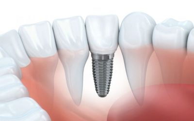 Solutions for Missing Teeth Start With Cosmetic Dental Implants Woodbridge VA Specialists Provide