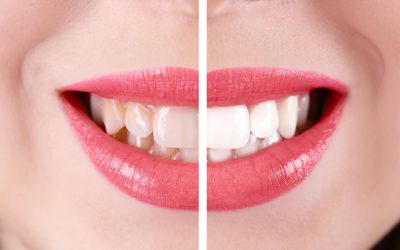 Teeth Whitening Vista CA Options That Deliver Noticeable and Safe Results Fast