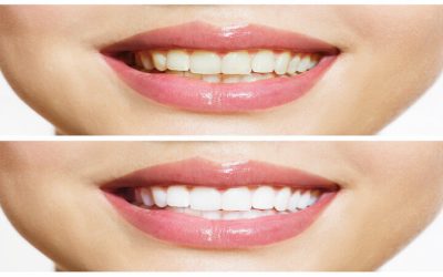 Teeth Cleaning Midland MI Services to Keep Your Smile Healthy and Confident