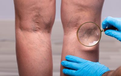 Achieve Smoother Legs with Varicose Vein Treatment Rolling in Meadows IL Solutions